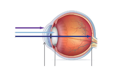 Macular Degeneration